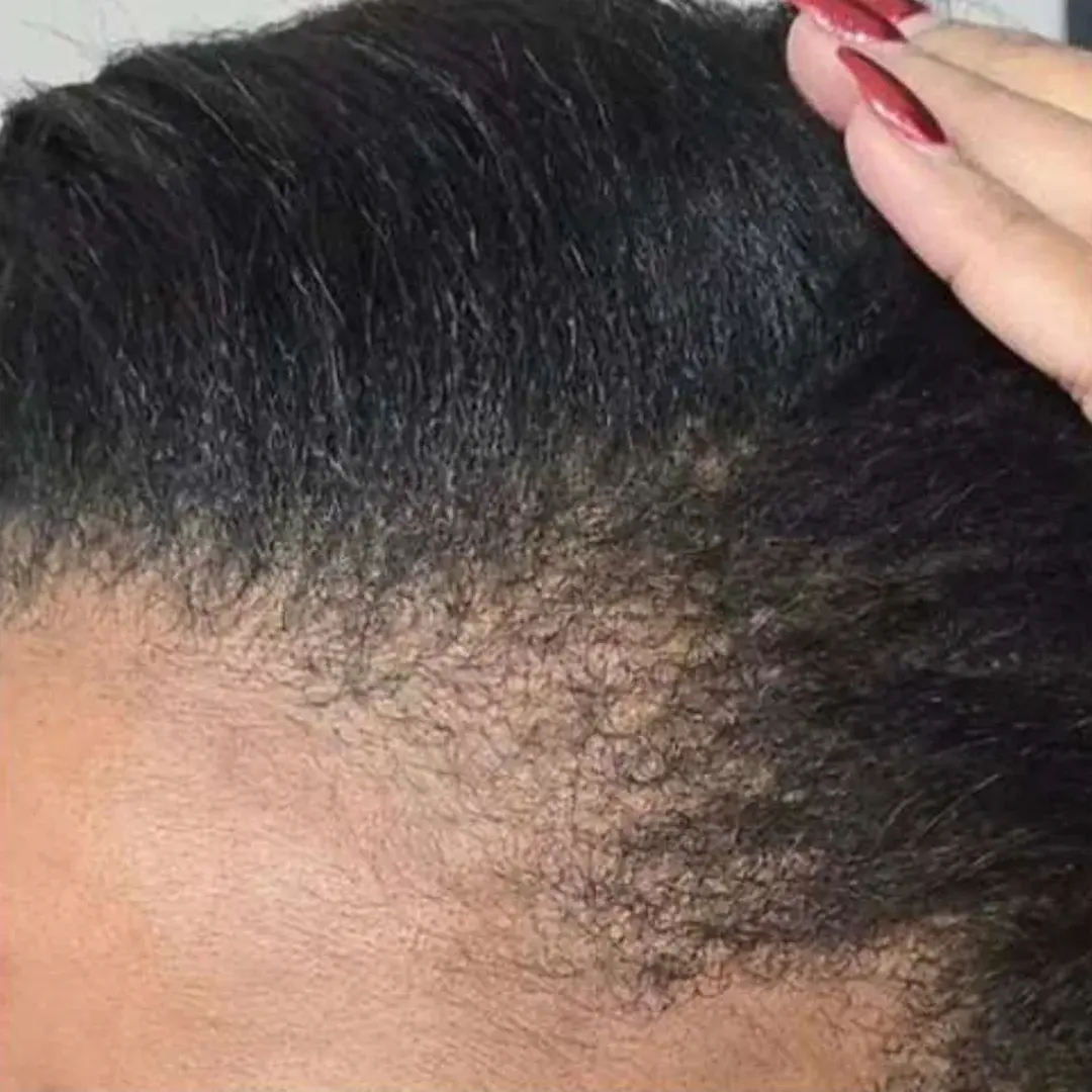 NOUVAGrow Hair Restoration After Result