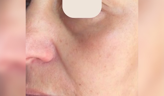 After Treatment Result