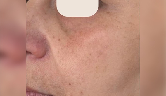 Before Treatment Result